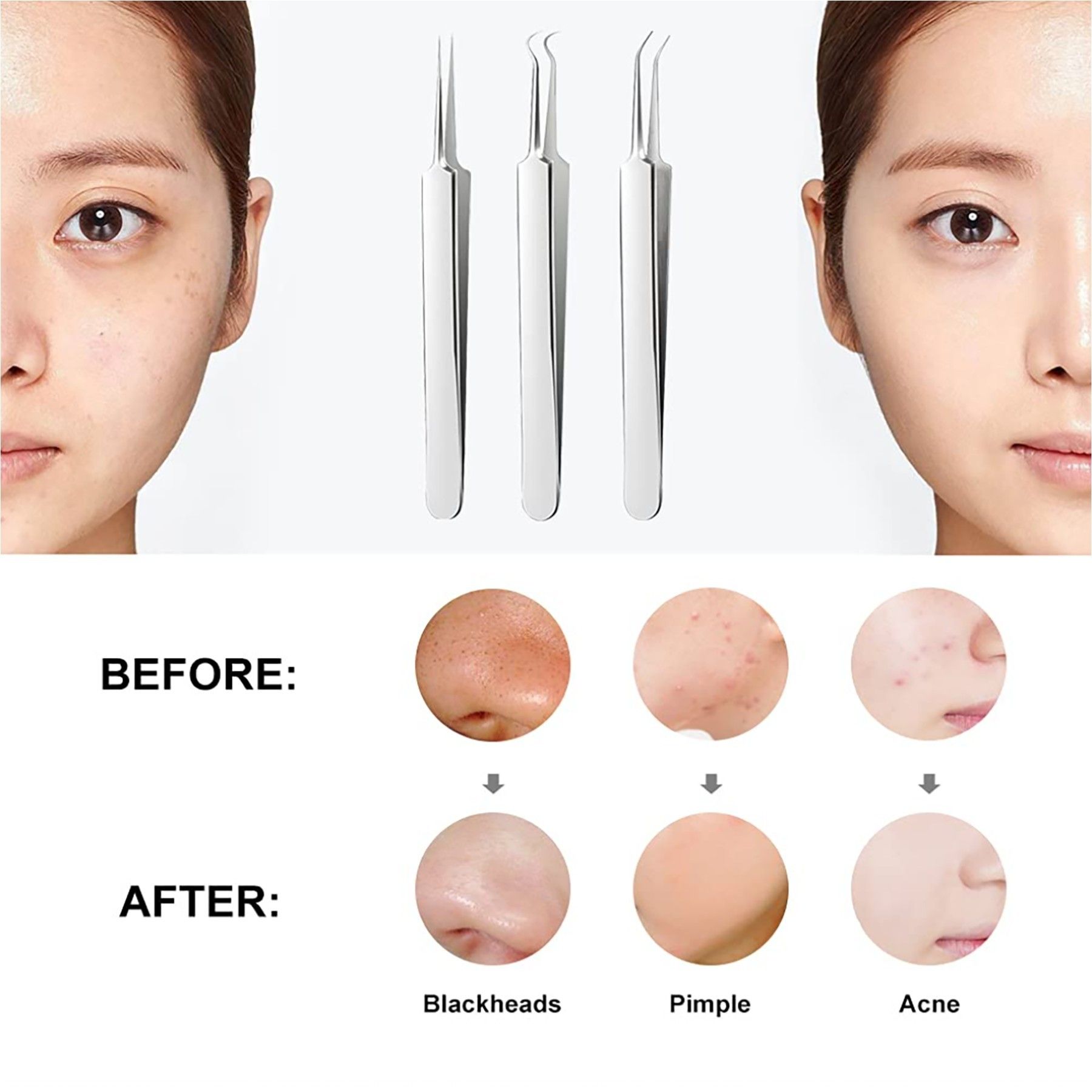 Pimple Popper Tool Kit - Image 2